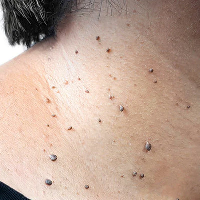 <strong>Verruga cutánea pigmentada</strong>